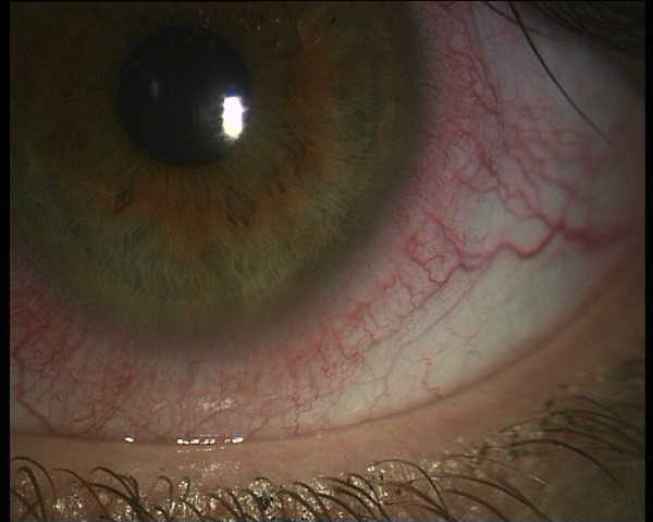 Nouveaux vaisseaux sanguins dans l'oeil à cause des lentilles de contact